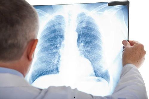 科兴员工爆料肺结节视频,揭示疫苗生产员工健康隐患  第3张